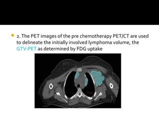  2.The PET images of the pre chemotherapy PET/CT are used
to delineate the initially involved lymphoma volume, the
GTV-PET as determined by FDG uptake
 