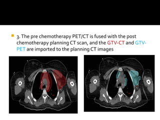  3.The pre chemotherapy PET/CT is fused with the post
chemotherapy planning CT scan, and the GTV-CT and GTV-
PET are imported to the planning CT images
 