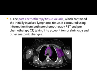  4.The post chemotherapy tissue volume, which contained
the initially involved lymphoma tissue, is contoured using
information from both pre chemotherapy PET and pre
chemotherapy CT, taking into account tumor shrinkage and
other anatomic changes.
 