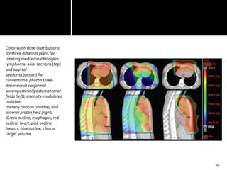 96
Color-wash dose distributions
for three different plans for
treating mediastinal Hodgkin
lymphoma: axial sections (top)
and sagittal
sections (bottom) for
conventional photon three-
dimensional conformal
anteroposterior/posteroanterior
fields (left), intensity-modulated
radiation
therapy photon (middle), and
anterior proton field (right).
Green outline, esophagus; red
outline, heart; pink outline,
breasts; blue outline, clinical
target volume.
 