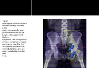 Typical
anteroposterior/posteroanterio
r field for treating unilateral
pelvic
nodes, in this case for a 34-
year-old man with stage IIA
lymphocyte-predominant
Hodgkin
lymphoma.T he initial positron
emission tomography+ nodes
are shown in blue.T he field
includes margins of at least 2
cm medial and lateral to the
nodes and a field width of at
least
6 cm.
 