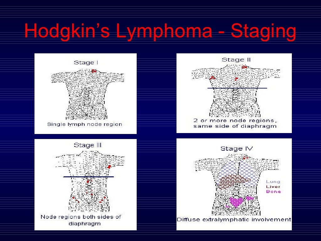 Hodgkin’S And Non Hodgkin’S Lymphoma
