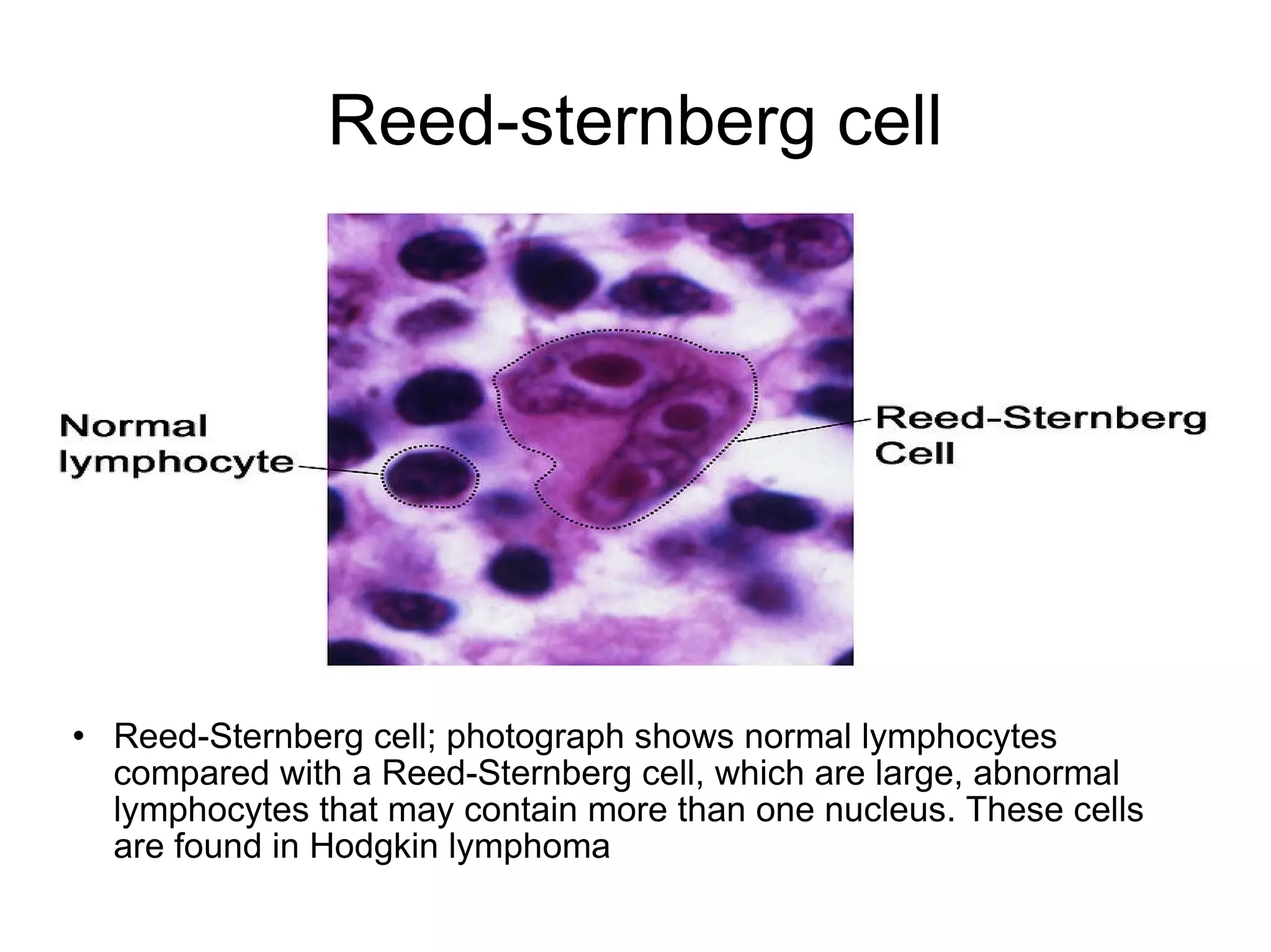 Hodgkins Lymphoma PPS Hodgkins Lymphoma PPS