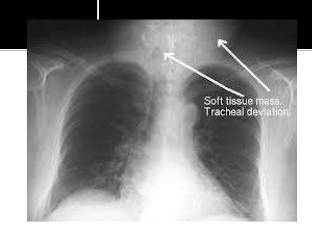 Hodgkin's lymphoma