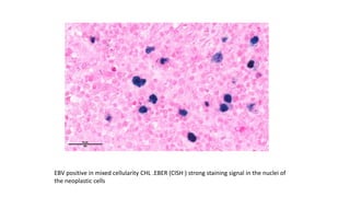 Hodgkins lymphoma ppt.pptx