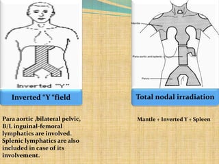 Spleen Inverted Hodgkin's lymphoma early stage management | PPTX