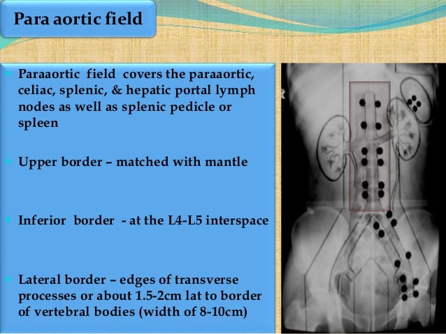 Hodgkin's lymphoma early stage management
