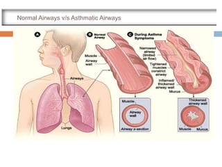 Normal Airways v/s Asthmatic Airways
 
