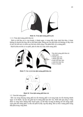 41
Hình 16. Tràn dịch màng phổi tự do
1.1.2. Tràn dịch màng phổi khu trú
Dịch có thể khu trú ở vòm hoành, ở thành ngực, ở trung thất, hoặc rãnh liên thùy, ít hoặc
không di chuyển khi thay đổi tư thế bệnh nhân. Bóng mờ của dịch khu trú thường có đáy tròn
rõ nét, bờ trên mờ và chiều cao lớn hơn chiều rộng. Cần phân biệt với u màng phổi.
Dịch bị khu trú khi có xơ phổi, phù tổ chức kẽ, hoặc dính màng phổi.
Hình 17. Các vị trí tràn dịch màng phổi khu trú
Hình 18. Tràn dịch màng phổi khu trú
1.2. Tràn khí màng phổi
Khí vào trong khoang màng phổi do tổn thương phổi và là tạng hoặc do tổn thương thành
ngực và lá thành. Áp lực âm giữa hai lá màng phổi kéo khí vào. Hình ảnh quá sáng ở vùng
đỉnh và vùng nách, không thấy huyết quản, có thể thấy lá tạng là đường mờ rất mỏng ngăn
cách giữa khí màng phổi và nhu mô phổi bị đẩy xẹp thụ động. Khí có thể ở màng phổi trung
thất phía trong vùng đỉnh.
Tràn dịch màng phổi khu trú
a đỉnh phổi
b thành ngực sau
c thành ngực bên
d rảnh liên thuỳ nhỏ
e rảnh liên thuỳ lớn
f trên cơ hoành
 