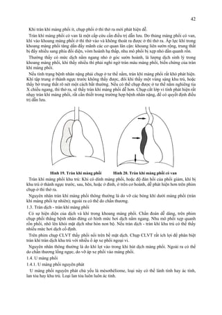 42
Khi tràn khí màng phổi ít, chụp phổi ở thì thở ra mới phát hiện dễ.
Tràn khí màng phổi có van là một cấp cứu cần điều trị dẫn lưu. Do thủng màng phổi có van,
khí vào khoang màng phổi ở thì thở vào và không thoát ra được ở thì thở ra. Áp lực khí trong
khoang màng phổi tăng dần đẩy mãnh các cơ quan lân cận: khoang liên sườn rộng, trung thất
bị đẩy nhiều sang phía đối diện, vòm hoành hạ thấp, nhu mô phổi bị xẹp nhỏ dần quanh rốn.
Thường thấy có mức dịch nằm ngang nhỏ ở góc sườn hoành, là lượng dịch sinh lý trong
khoang màng phổi, khi thấy nhiều thì phải nghi ngờ tràn máu màng phổi, biến chứng của tràn
khí màng phổi.
Nếu tình trạng bệnh nhân nặng phải chụp ở tư thế nằm, tràn khí màng phổi rất khó phát hiện.
Khí tập trung ở thành ngực trước không thấy được, đôi khi thấy một vùng sáng khu trú, hoặc
thấy bờ trung thất rõ nét một cách bất thường. Nếu có thể chụp được ở tư thế nằm nghiêng tia
X chiếu ngang, thì thở ra, sẽ thấy tràn khí màng phổi dễ hơn. Chụp cắt lớp vi tính phát hiện rất
nhạy tràn khí màng phổi, rất cần thiết trong trường hợp bệnh nhân nặng, để có quyết định điều
trị dẫn lưu.
Hình 19. Tràn khí màng phổi Hình 20. Tràn khí màng phổi có van
Tràn khí màng phổi khu trú: Khi có dính màng phổi, hoặc độ đàn hồi của phổi giảm, khí bị
khu trú ở thành ngực trước, sau, bên, hoặc ở đỉnh, ở trên cơ hoành, dễ phát hiện hơn trên phim
chụp ở thì thở ra.
Nguyên nhân tràn khí màng phổi thông thường là do vỡ các bóng khí dưới màng phổi (tràn
khí màng phổi tự nhiên); ngoài ra có thể do chấn thương.
1.3. Tràn dịch - tràn khí màng phổi
Có sự hiện diện của dịch và khí trong khoang màng phổi. Chẩn đoán dễ dàng, trên phim
chụp phổi thẳng bệnh nhân đứng có hình mức hơi dịch nằm ngang. Nhu mô phổi xẹp quanh
rốn phổi, nhô lên khỏi mặt dịch như hòn non bộ. Nếu tràn dịch - tràn khí khu trú có thể thấy
nhiều mức hơi dịch cố định.
Trên phim chụp CLVT thấy phổi nổi trên bề mặt dịch. Chụp CLVT rất ích lợi để phân biệt
tràn khí tràn dịch khu trú với nhiều ổ áp xe phổi ngoại vi.
Nguyên nhân thông thường là do khí lọt vào trong khi hút dịch màng phổi. Ngoài ra có thể
do chấn thương lồng ngực, do vỡ áp xe phổi vào màng phổi.
1.4. U màng phổi
1.4.1. U màng phổi nguyên phát
U màng phổi nguyên phát chủ yếu là mésothéliome, loại này có thể lành tính hay ác tính,
lan tỏa hay khu trú. Loại lan tỏa luôn luôn ác tính.
 