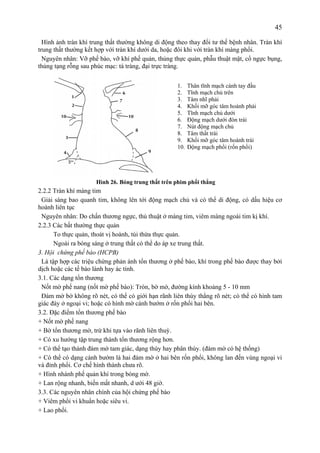 45
Hình ảnh tràn khí trung thất thường không di động theo thay đổi tư thế bệnh nhân. Tràn khí
trung thất thường kết hợp với tràn khí dưới da, hoặc đôi khi với tràn khí màng phổi.
Nguyên nhân: Vỡ phế bào, vỡ khí phế quản, thủng thực quản, phẫu thuật mặt, cổ ngực bụng,
thủng tạng rỗng sau phúc mạc: tá tràng, đại trực tràng.
Hình 26. Bóng trung thất trên phim phổi thẳng
2.2.2 Tràn khí màng tim
Giải sáng bao quanh tim, không lên tới động mạch chủ và có thể di động, có dấu hiệu cơ
hoành liên tục
Nguyên nhân: Do chấn thương ngực, thủ thuật ở màng tim, viêm màng ngoài tim kị khí.
2.2.3 Các bất thường thực quản
To thực quản, thoát vị hoành, túi thừa thực quản.
Ngoài ra bóng sáng ở trung thất có thể do áp xe trung thất.
3. Hội chứng phế bào (HCPB)
Là tập hợp các triệu chứng phản ánh tổn thương ở phế bào, khí trong phế bào được thay bởi
dịch hoặc các tế bào lành hay ác tính.
3.1. Các dạng tổn thương
Nốt mờ phế nang (nốt mờ phế bào): Tròn, bờ mờ, đường kính khoảng 5 - 10 mm
Đám mờ bờ không rõ nét, có thể có giới hạn rãnh liên thùy thẳng rõ nét; có thể có hình tam
giác đáy ở ngoại vi; hoặc có hình mờ cánh bướm ở rốn phổi hai bên.
3.2. Đặc điểm tổn thương phế bào
+ Nốt mờ phế nang
+ Bờ tổn thương mờ, trừ khi tựa vào rãnh liên thuỳ.
+ Có xu hướng tập trung thành tổn thương rộng hơn.
+ Có thể tạo thành đám mờ tam giác, dạng thùy hay phân thùy. (đám mờ có hệ thống)
+ Có thể có dạng cánh bướm là hai đám mờ ở hai bên rốn phổi, không lan đến vùng ngoại vi
và đỉnh phổi. Cơ chế hình thành chưa rõ.
+ Hình nhánh phế quản khí trong bóng mờ.
+ Lan rộng nhanh, biến mất nhanh, d ưới 48 giờ.
3.3. Các nguyên nhân chính của hội chứng phế bào
+ Viêm phổi vi khuẩn hoặc siêu vi.
+ Lao phổi.
1. Thân tĩnh mạch cánh tay đầu
2. Tĩnh mạch chủ trên
3. Tâm nhĩ phải
4. Khối mỡ góc tâm hoành phải
5. Tĩnh mạch chủ dưới
6. Động mạch dưới đòn trái
7. Nút động mạch chủ
8. Tâm thất trái
9. Khối mỡ góc tâm hoành trái
10. Động mạch phổi (rốn phổi)
 