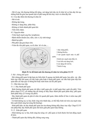 47
- Mờ tổ ong: tổn thương không hồi phục, mờ dạng lưới dày do tổ chức kẽ xơ hóa dày lên tạo
những hình đa giác bao quanh một số phế nang đã tiêu hủy vách và chứa đầy khí.
4.2. Các đặc điểm tổn thương tổ chức kẽ
- Mờ rõ nét.
- Không tập trung.
- Không có dạng thùy, phân thùy.
- Không có hình nhánh phế quản khí.
- Tiến triển chậm.
4.3. Nguyên nhân
- Viêm bạch mạch ung thư, lymphome
- Bệnh nhiễm khuẩn (lao, nấm, siêu vi, ký sinh trùng)
- Bệnh bụi phổi.
- Phù phổi cấp giai đoạn sớm.
- Viêm tắc tiểu phế quản, xơ tổ chức kẽ vô căn, ...
Hình 29. Sơ đồ hình ảnh tổn thương tổ chức kẻ trên phim CLVT
5. Hội chứng phế quản
Hội chứng phế quản là tập hợp các biểu hiện X quang của bệnh phế quản, bao gồm các dấu
hiệu trực tiếp liên quan với dày hoặc giãn hoặc ứ đọng phế quản, các dấu hiện gián tiếp liên
quan đến các hậu quả về thông khí hoặc tuần hoàn của tắc phế quản.
5.1. Dấu hiệu trực tiếp
5.1.1. Dày thành phế quản
Bình thường thành phế quản chỉ thấy ở phế quản gốc và phế quản thuỳ cạnh rốn phổi. Trên
phim chụp CLVT với những lớp cắt mỏng sẽ thấy được thành phế quản phân thùy, phế quản
dưới phân thùy (2/3 trong của phổi).
Dày thành phế quản do phù tổ chức kẽ quanh phế quản, thâm nhiễm tế bào ở niêm mạc phế
quản hoặc do xơ.
Có hình đường ray xe lửa, hình vòng tròn thành dày, có thể thấy hình mờ tròn của mạch máu
bên cạnh (hình súng hai nòng bất thường).
Hình phổi bẩn: do dày thành phế quản lan tỏa nhưng không thấy được trực tiếp. Chụp CLVT
cho phép thấy dày thành phế quản nhỏ kèm giãn phé quản hoặc không.
5.1.2. Giãn phế quản
- Hình đường ray xe lửa, hình súng hai nòng với phế quản có kích thước lớn hơn động mạch
đi kèm.
- Thành phế quản dày không đều, không song song.
1 dày màng phổi,
2 đường Kerley,
3 mờ quanh mạch máu và phế
quản,
4 kính mờ, mạch máu thấy rõ,
5 các kiểu mờ dạng lưới,
6 các dạng nốt mờ kẻ,
7 hình tổ ong.
 