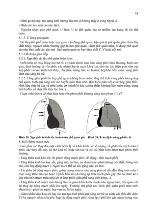 48
- Hình giả tổ ong: mờ dạng lưới nhưng khu trú và không thấy ở vùng ngoại vi.
- Hình các kén nhỏ có mức dịch.
Nguyên nhân giãn phế quản: U lành, U ác phế quản, lao sơ nhiễm, lao hang, dị vật phế
quản.
5.1.3. Ứ đọng phế quản
Do tăng tiết phế quản hoặc suy giảm vận động phế quản, hậu quả là phế quản giãn chứa đầy
chất nhày, nguyên nhân thường gặp là hen phế quản, viêm phế quản mãn. Ứ đọng phế quản
tạo nên hình ảnh các giải mờ hình ngón gant tay hay hình chữ Y, V hoặc nốt mờ.
5.2. Dấu hiệu gián tiếp
5.2.1. Xẹp phổi do tắc phế quản hoàn toàn:
Điển hình sẽ thấy bóng mờ bờ rõ, có kích thước nhỏ hơn vùng phổi bình thường, hình tam
giác, đỉnh hướng về rốn phổi; các nhánh huyết quản khép lại; với các dấu hiệu gián tiếp của
xẹp phổi: co kéo rãnh liên thùy, rốn phổi, trung thất, cơ hoành; hẹp khe liên sườn; vùng phổi
lành qúa sáng bù trừ.
5.2.2. Căng giãn phổi do hẹp phế quản không hoàn toàn: tăng thể tích vùng phổi tương ứng
phế quản, hình quá sáng với các huyết quản thưa nhỏ. Dấu hiệu gián tiếp của căng giãn phổi:
rãnh liên thùy bị đẩy về phía lành; cơ hoành bị đẩy xuống thấp, khoảng liên sườn rộng, trung
thất bị đẩy về phía đối diện lúc thở ra.
Chụp ở thì thở ra dễ phát hiện hơn trên phim phổi thường cũng như phim CLVT.
Hình 30. Xẹp phổi trái do tắc hoàn toàn phế quản gốc Hình 31. Tràn dịch màng phổi trái
6. Hội chứng mạch máu
Bao gồm các thay đổi một cách bệnh lý về khẩu kính, về số lượng, về phân bố mạch máu ở
phổi; các thay đổi này có thể khu trú hoặc lan tỏa và có thể phát hiện được trên phim phổi
thường.
- Tăng khẩu kính khu trú: túi phình động mạch phổi; dò động - tĩnh mạch phổi.
- Tăng khẩu kính lan tỏa: sốt, gắng sức, có thai, có shunt trái - phải (thông liên thất, thông liên
nhĩ, còn ống động mạch ). Ngoài ra có thể do sốt, gắng sức, có thai.
- Tái phân bố động mạch phổi: giảm lượng máu ở một vùng phổi sẽ dẫn đến tăng tưới máu ở
một vùng khác lân cận hoặc ở phổi bên kia (do tăng áp tĩnh mạch phổi gây phù tổ chức kẽ ở
đáy nên lưới mạch máu tăng lên ở đỉnh phổi, giãn phế nang diện rộng,...).
- Tăng khẩu kính mạch máu trung tâm và giảm khẩu kính mạch máu ngoại biên, liên quan với
sự tăng áp động mạch phổi lâu ngày. Thường thứ phát sau bệnh phế quản phổi mãn tính,
shunt trái - phải lâu ngày, hẹp van hai lá lâu ngày.
- Giảm khẩu kính khu trú hay lan tỏa tạo hình phổi quá sáng có thể so sánh với phổi đối diện.
Có ba nguyên nhân chủ yếu: hẹp tắc động mạch phổi; tăng áp ở phế bào gây giảm lượng máu
 