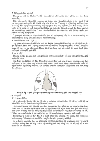 50
2. Viêm phổi thùy cấp tính
Thường do phế cầu khuẩn. Có thể viêm một hay nhiều phân thùy, có khi một thùy hoặc
nhiều thùy.
Thùy giữa hay bị viêm phổi, còn được gọi là tam giác viêm phổi, kế đến là thùy dưới. Ở trẻ
em hay gặp là thùy giữa, kế tiếp là thùy trên. Hình ảnh X quang là hội chứng phế bào: hình
mờ đồng đều; dạng tam giác tương ứng một phân thùy hay một thùy; có đỉnh hướng về rốn
phổi, đáy ở ngoại vi; cạnh thường là một hay hai rãnh liên thùy, rõ nét, có thể thẳng hay hơi
lồi nhưng không bao giờ lõm. Ở giữa có thể thấy hình phế quản chứa khí. Không có dấu hiệu
co kéo các tạng xung quanh.
Ở giai đoạn sớm và giai đoạn thoái triển hình mờ không đồng đều, do sự hiện diện cùng lúc
nhóm phế bào thông khí và nhóm phế bào tổn thương.
3. Phế quản phế viêm (PQPV)
Hay gặp ở trẻ em do các vi khuẩn sinh mủ. PQPV thường là biến chứng sau các bệnh sởi, ho
gà, bạch hầu. Hình ảnh X quang là các hình mờ phế bào không đồng nhất, to nhỏ không đều
nhau, bờ mờ, rải rác nhiều nơi, không tập trung hoặc một số có thể tập trung thành đám,
không có nhánh phế quản khí.
4. Áp xe phổi
Thường là hậu quả của một bệnh phổi cấp tính không điều trị tốt như viêm phổi thùy, phế
quản phế viêm.
Giai đoạn đầu là hình mờ đậm đồng đều, bờ mờ. Khi chất hoại tử được tống ra ngoài theo
phế quản, sẽ thấy hình hang với mức dịch ngang, thành hang mỏng, bờ trong đều nhẵn, bờ
ngoài mờ do hội chứng phế bào. Khi điều trị tốt hình viêm phổi xung quanh biến mất, hang
thu nhỏ dần.
Hình 32. Áp xe phổi (phổi phải) và tràn dịch-tràn khí màng phổi khu trú (phổi trái)
5. Lao phổi
5.1. Lao sơ nhiễm
Là sự xâm nhập lần đầu tiên của BK vào cơ thể chưa miễn dịch lao. Có thể xẩy ra bất kỳ lúc
nào từ khi trẻ còn nhỏ cho đến người trưởng thành.
Hình ảnh X quang điển hình là phức hợp lao nguyên thủy gồm nốt lao nguyên thủy, hạch
viêm phổi lao và viêm bạch mạch. Nốt lao nguyên thủy là một ổ viêm phổi giới hạn, bã đậu
hóa, ở bất cứ vùng nào của phổi; một hoặc nhiều hạch rốn phổi cùng bên hoặc khác bên lớn.
Giữa ổ lao nguyên thủy và hạch viêm lao nối với nhau là đường mờ viêm bạch mạch.
Trong thực tế hiếm khi thấy đầy đủ 3 thành phần trên; khoảng 50% trường hợp phim phổi
bình thường. Chẩn đoán lao sơ nhiễm chủ yếu dựa vào nguồn lây và IDR.
Đa số lao sơ nhiễm tự khỏi sau khi tồn tại có thể nhiều tháng, để lại các dấu tích vôi hóa về
sau hoặc không. Đôi khi xẩy ra tràn dịch màng phổi hay màng tim, lao kê; một số ít biến
thành lao sau sơ nhiễm.
 