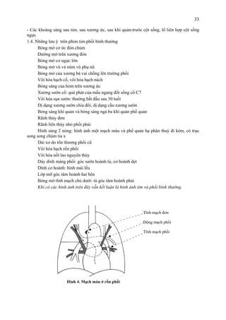 33
- Các khoảng sáng sau tim, sau xương ức, sau khí quản-trước cột sống, lổ liên hợp cột sống
ngực
1.4. Những lưu ý trên phim tim phổi bình thường
Bóng mờ cơ ức đòn chủm
Đường mờ trên xương đòn
Bóng mờ cơ ngực lớn
Bóng mờ vú và núm vú phụ nũ
Bóng mờ của xương bả vai chồng lên trường phổi
Vôi hóa hạch cổ, vôi hóa hạch nách
Bóng sáng của hỏm trên xương ức
Xương sườn cổ: quá phát của mấu ngang đốt sống cổ C7
Vôi hóa sụn sườn: thường bắt đầu sau 30 tuổi
Dị dạng xương sườn chia đôi, dị dạng cầu xương sườn
Bóng sáng khí quản và bóng sáng ngả ba khí quản phế quản
Rãnh thùy đơn
Rãnh liên thùy nhỏ phổi phải
Hình súng 2 nòng: hình ảnh một mạch máu và phế quản hạ phân thuỳ đi kèm, có trục
song song chùm tia x
Dải xơ do tổn thương phổi cũ
Vôi hóa hạch rốn phổi
Vôi hóa nốt lao nguyên thủy
Dày dính màng phổi: góc sườn hoành tù, cơ hoành dẹt
Dính cơ hoành: hình mái lều
Lớp mỡ góc tâm hoành hai bên
Bóng mờ tĩnh mạch chủ dưới: tù góc tâm hoành phải
Khi có các hình ảnh trên đây vẫn kết luận là hình ảnh tim và phổi bình thường.
Hình 4. Mạch máu ở rốn phổi
Tĩnh mạch đơn
Động mạch phổi
Tĩnh mạch phổi
 