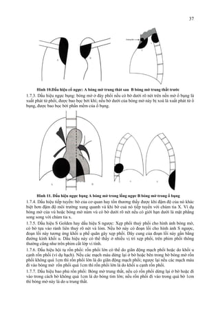 37
Hình 10.Dấu hiệu cổ ngực: A bóng mờ trung thát sau B bóng mờ trung thất trước
1.7.3. Dấu hiệu ngực bụng: bóng mờ ở đáy phổi nếu có bờ dưới rõ nét trên nền mờ ổ bụng là
xuất phát từ phổi, được bao bọc bởi khí; nếu bờ dưới của bóng mờ này bị xoá là xuất phát từ ổ
bụng, được bao bọc bởi phần mềm của ổ bụng.
Hình 11. Dấu hiệu ngực bụng A bóng mờ trong lồng ngực B bóng mờ trong ổ bụng
1.7.4. Dấu hiệu tiếp tuyến: bờ của cơ quan hay tổn thương thấy được khi đậm độ của nó khác
biệt hơn đậm độ môi trường xung quanh và khi bờ cuả nó tiếp tuyến với chùm tia X. Ví dụ
bóng mờ của vú hoặc bóng mờ núm vú có bờ dưới rõ nét nếu có giới hạn dưới là mặt phẳng
song song với chùm tia x.
1.7.5. Dấu hiệu S Golden hay dấu hiệu S ngược: Xẹp phổi thuỳ phổi cho hình ảnh bóng mờ,
có bờ tựa vào rảnh liên thuỳ rõ nét và lỏm. Nếu bờ này có đoạn lồi cho hình ảnh S ngược,
đoạn lồi này tương ứng khối u phế quãn gây xẹp phổi. Dây cung của đoạn lồi này gần bằng
đường kính khối u. Dấu hiệu này có thể thấy ở nhiều vị trí xẹp phổi, trên phim phổi thông
thường cũng như trên phim cắt lớp vi tính.
1.7.6. Dấu hiệu hội tụ rốn phổi: rốn phổi lớn có thể do giãn động mạch phổi hoặc do khối u
cạnh rốn phổi (ví dụ hạch). Nếu các mạch máu dừng lại ở bờ hoặc bên trong bờ bóng mờ rốn
phổi không quá 1cm thì rốn phổi lớn là do giãn động mạch phổi; ngược lại nếu các mạch máu
đi vào bóng mờ rốn phổi quá 1cm thì rốn phổi lớn là do khối u cạnh rốn phổi.
1.7.7. Dấu hiệu bao phủ rốn phổi: Bóng mờ trung thất, nếu có rốn phổi dừng lại ở bờ hoặc đi
vào trong cách bờ không quá 1cm là do bóng tim lớn; nếu rốn phổi đi vào trong quá bờ 1cm
thì bóng mờ này là do u trung thất.
 