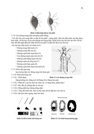38
Hình 12.Dấu hiệu hội tụ rốn phổi
1.7.8. Các đường trung thất trên phim phổi thẳng
Vài cấu trúc của trung thất có dấu ấn lên phổi - màng phổi. Nếu hai điều kiện sau đây được
thỏa mãn, vết ấn này sẽ tạo nên đường mờ trung thất, chính là bờ của cấu trúc tạo nên vết ấn: -
thay đổi đột ngột đậm độ: đậm độ khí của phổi và đậm độ dịch của cấu trúc
- bờ cấu trúc tiếp tuyến với chùm tia X
+ Đường trung thất trước (1)
+ Đường trung thất sau (2)
+ Đường cạnh tĩnh mạch đơn (3)
+ Các đường mạch máu trên (4) (5)
+ Đường cạnh động mạch chủ (6)
+ Đường cạnh cột sống trái (7)
+ Đường cạnh thực quản (8)
+ Đường cạnh tĩnh mạch chủ dưới (9)
1.7.9. Hình ảnh quá sáng
lan tỏa hay khu trú. Bóng sáng tròn hoặc giải sáng.
1.7.10. Hình ảnh bóng mờ:
1.7.10.1. Hình dạng Hình 13. Các đường trung thất
Dạng đường mờ, băng mờ, bờ.Dạng tròn. Dạng tam giác
1.7.10.2. Phân bố: Lan tỏa, Rải rác, Khu trú: có dạng thùy, phân thùy?
1.7.10.3. Bờ: đều rõ, không đều rõ, bờ mờ
1.7.10.4. Đồng nhất hay không đồng nhất
1.7.10.5. Thay đổi hình ảnh: theo tư thế, theo thì hô hấp thở vào, thở ra
1.7.10.6. Bờ trên nằm ngang: mức hơi dịch
Hình 14.Mô tả hình ảnh bóng mờ Hình 15. Các hình hang thường gặp
 