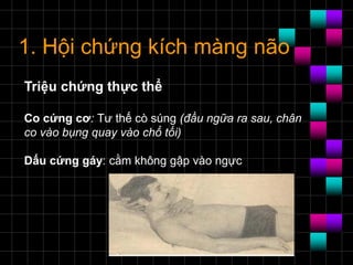 1. Hội chứng kích màng não
Triệu chứng thực thể
Co cứng cơ: Tư thế cò súng (đầu ngữa ra sau, chân
co vào bụng quay vào chổ tối)
Dấu cứng gáy: cằm không gập vào ngực
 