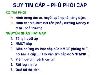 SUY TIM CẤP – PHÙ PHỔI CẤP
XQ TIM PHỔI
 Hình bóng tim to, huyết quản phổi tăng đậm,
 Hình cánh bƣớm hai rốn phổi, đƣờng Kerley B
ở hai phế trƣờng...
NGUYÊN NHÂN HAY GẶP
1. Tăng huyết áp
2. NMCT cấp
3. Biến chứng cơ học cấp của NMCT (thủng VLT,
hở hai lá cấp…), Hở van tim cấp do VNTMNK...
4. Viêm cơ tim, bệnh cơ tim
5. Rối loạn nhịp
6. Quá tải thể tích...
 
