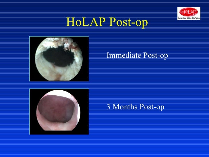 Holmium Laser Ablation of the Prostate webinar slides