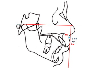Sls

      3 mm
      +/- 1
      Ls
 