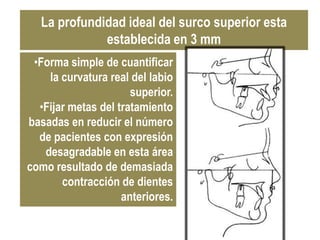 La profundidad ideal del surco superior esta
             establecida en 3 mm
 •Forma simple de cuantificar
    la curvatura real del labio
                      superior.
  •Fijar metas del tratamiento
basadas en reducir el número
  de pacientes con expresión
   desagradable en esta área
como resultado de demasiada
       contracción de dientes
                    anteriores.
 
