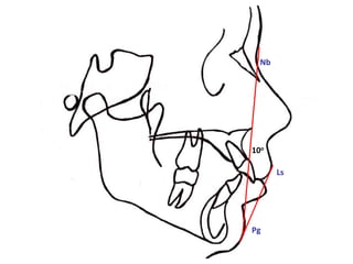 Nb




10o

       Ls




Pg
 