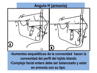 Angulo H (armonía)




•Aumentos esqueléticos de la convexidad hacen la
     convexidad del perfil del tejido blando
•Complejo facial entero debe ser balanceado y estar
             en armonía con su tipo.
 