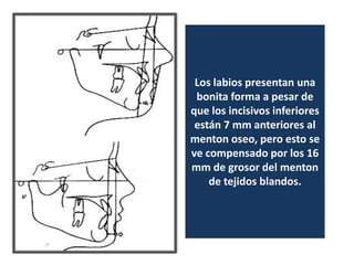 Los labios presentan una
 bonita forma a pesar de
que los incisivos inferiores
 están 7 mm anteriores al
menton oseo, pero esto se
ve compensado por los 16
mm de grosor del menton
    de tejidos blandos.
 