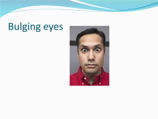 Bulging eyes 