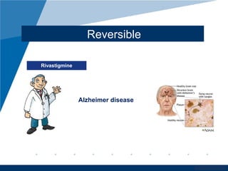 www.company.com
Reversible
Rivastigmine
Alzheimer disease
 