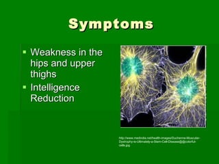 Symptoms Weakness in the hips and upper thighs Intelligence Reduction http://www.medindia.net/health-images/Duchenne-Muscular-Dystrophy-is-Ultimately-a-Stem-Cell-Disease@@colorful-cells.jpg 