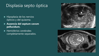 Displasia septo óptica
 Hipoplasia de los nervios
ópticos y del quiasma.
 Ausencia del septum cavum
pellucidum.
 Hemisferios cerebrales
completamente separados.
 