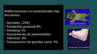 Malformaciones no craneofaciales mas
frecuentes:
• Genitales ( 24%)
• Polidactilia postaxial 8%
• Vertebras 5%
• Acortamiento de extremidades
inferiores 4%
• Transposicion de grandes vasos 4%
displasia tanatrófica
ctrodactilia ( Sd. Hartsfield)
 