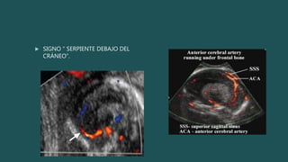  SIGNO “ SERPIENTE DEBAJO DEL
CRÁNEO”.
 