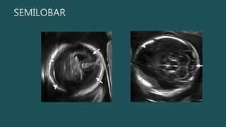 SEMILOBAR
 
