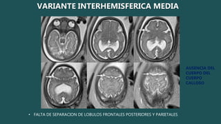 • FALTA DE SEPARACION DE LOBULOS FRONTALES POSTERIORES Y PARIETALES
AUSENCIA DEL
CUERPO DEL
CUERPO
CALLOSO
VARIANTE INTERHEMISFERICA MEDIA
 