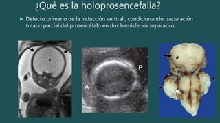 ¿Qué es la holoprosencefalia?
 Defecto primario de la inducción ventral , condicionando separación
total o parcial del prosencéfalo en dos hemisferios separados.
h
d
 