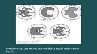 Syntelencefalia: una variante interhemisférica medial, recientemente
descrita.
46-50%
18 % 10%
 