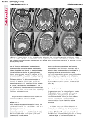 Figura 20. MIH. Imágenes axiales de RM semi-Fourier ponderadas en T2 obtenidas a las 33 semanas de edad gestacional estimada. Nótese la falta de
separación de la línea media en las áreas frontal posterior y parietal (*), mientras que las regiones rostral y posterior del cerebro están divididas normalmente
y las órbitas están espaciadas normalmente. Además, tenga en cuenta las fisuras de Silvio orientadas verticalmente (flechas), que se conectan de manera
anormal a través del vértice.
(dieciséis). La presencia de un quiste dorsal se
correlaciona fuertemente con la fusión talámica, de ahí la alta
frecuencia con HPE alobar. Se cree que el flujo de líquido
cefalorraquídeo que sale del tercer
falta de separación de la línea media en las áreas frontal
posterior y parietal, mientras que las áreas más polares del
cerebro normalmente están divididas. En el desarrollo paralelo,
normalmente se forman la rodilla y el esplenio del cuerpo
calloso, pero el cuerpo está ausente (19). Las fisuras de Silvio
en pacientes con MIH a menudo están orientadas verticalmente
y anormalmente conectadas a través de la línea media sobre el
vértice del cerebro (19). Se observa que dos tercios de los
pacientes con MIH tienen displasia cortical o materia gris
heterotópica subcortical (19), y se encontró un quiste dorsal en
el 40% (18). Las características distintivas entre HPE lobar y
MIH son la ubicación de la disgenesia callosa (genu y tribuna en
HPE lobar versus cuerpo en MIH) (16) y el área de no separación
hemisférica descrita anteriormente.
el ventrículo está obstruido por la fusión de los tálamos y,
como resultado, el tercer ventrículo se hincha hacia atrás en
el punto de menor resistencia en el receso suprapineal (16). El
quiste dorsal de HPE se ha confundido con un quiste
interhemisférico asociado con agenesia del cuerpo calloso, pero
la distinción puede hacerse por la presencia de hendidura
normal de los hemisferios cerebrales en el caso de agenesia
(16). En raras ocasiones, el quiste dorsal puede herniarse a
través de la fontanela anterior y formar un encefalocele en el
vértice (49).
Quiste dorsal Un
quiste dorsal casi siempre está presente en HPE alobar, y con
mucha menos frecuencia en HPE semilobar y HPE lobar (92%,
28% y 9%, respectivamente)
Como era de esperar, hay excepciones al axioma de
DeMyer, con 10% a 39% de los casos que carecen de una
correlación clara entre los subtipos de anomalías faciales y
cerebrales (27). Alobar HPE puede manifestarse solo con
dismorfismo facial menor entre el 15 % y el 20 % de las veces (9).
La mutación del gen ZIC2 está asociada con HPE: Af-
Ninguno de los 15 pacientes supervivientes con MIH tenía
anomalías craneofaciales en la línea media (18).
Anomalías faciales La frase
“la cara predice el cerebro” se originó con DeMyer y colegas
(7). Describieron una serie graduada de malformaciones
faciales medianas, desde ciclopía hasta etmocefalia,
cebocefalia, labio hendido mediano y el esbozo del filtrum-
premaxilar mediano (Tabla), que estaban altamente
correlacionadas con el tipo de malformación cerebral
subyacente.
284 Enero-Febrero 2015 radiographics.rsna.org
Machine Translated by Google
 