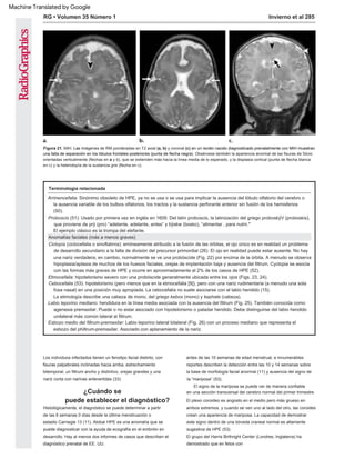 Terminología relacionada
Ciclopía (ciclocefalia o sinoftalmía): erróneamente atribuido a la fusión de las órbitas, el ojo único es en realidad un problema
de desarrollo secundario a la falta de división del precursor primordial (26). El ojo en realidad puede estar ausente. No hay
una nariz verdadera; en cambio, normalmente se ve una probóscide (Fig. 22) por encima de la órbita. A menudo se observa
hipoplasia/aplasia de muchos de los huesos faciales, orejas de implantación baja y ausencia del filtrum. Cyclopia se asocia
con las formas más graves de HPE y ocurre en aproximadamente el 2% de los casos de HPE (52).
Labio leporino mediano: hendidura en la línea media asociada con la ausencia del filtrum (Fig. 25). También conocida como
agenesia premaxilar. Puede o no estar asociado con hipotelorismo o paladar hendido. Debe distinguirse del labio hendido
unilateral más común lateral al filtrum.
Arrinencefalia: Sinónimo obsoleto de HPE, ya no se usa o se usa para implicar la ausencia del lóbulo olfatorio del cerebro o
la ausencia variable de los bulbos olfatorios, los tractos y la sustancia perforante anterior sin fusión de los hemisferios
(50).
Proboscis (51): Usado por primera vez en inglés en 1609. Del latín proboscis, la latinización del griego proboskÿV (proboskis),
que proviene de prÿ (pro) “adelante, adelante, antes” y bÿskw (bosko), “alimentar , para nutrir."
Etmocefalia: hipotelorismo severo con una probóscide generalmente ubicada entre los ojos (Figs. 23, 24).
Cebocefalia (53): hipotelorismo (pero menos que en la etmocefalia [9]), pero con una nariz rudimentaria (a menudo una sola
fosa nasal) en una posición muy apropiada. La cebocefalia no suele asociarse con el labio hendido (15).
Esbozo medio del filtrum-premaxilar: Labio leporino lateral bilateral (Fig. 26) con un proceso mediano que representa el
esbozo del philtrum-premaxilar. Asociado con aplanamiento de la nariz.
El ejemplo clásico es la trompa del elefante.
La etimología describe una cabeza de mono, del griego kebos (mono) y kephale (cabeza).
Anomalías faciales (más a menos graves)
RG • Volumen 35 Número 1 Invierno et al 285
El plexo coroideo es angosto en el medio pero más grueso en
ambos extremos, y cuando se ven uno al lado del otro, las coroides
crean una apariencia de mariposa. La capacidad de demostrar
este signo dentro de una bóveda craneal normal es altamente
sugestiva de HPE (53).
Los individuos infectados tienen un fenotipo facial distinto, con
fisuras palpebrales inclinadas hacia arriba, estrechamiento
bitemporal, un filtrum ancho y distintivo, orejas grandes y una
nariz corta con narinas antevertidas (33).
El signo de la mariposa se puede ver de manera confiable
en una sección transversal del cerebro normal del primer trimestre.
El grupo del Harris Birthright Center (Londres, Inglaterra) ha
demostrado que en fetos con
Histológicamente, el diagnóstico se puede determinar a partir
de las 6 semanas 0 días desde la última menstruación o
estadio Carnegie 13 (11). Alobar HPE es una anomalía que se
puede diagnosticar con la ayuda de ecografía en el embrión en
desarrollo. Hay al menos dos informes de casos que describen el
diagnóstico prenatal de EE. UU.
antes de las 10 semanas de edad menstrual, e innumerables
reportes describen la detección entre las 10 y 14 semanas sobre
la base de morfología facial anormal (11) y ausencia del signo de
la “mariposa” (53).
¿Cuándo se
puede establecer el diagnóstico?
Figura 21. MIH. Las imágenes de RM ponderadas en T2 axial (a, b) y coronal (c) en un recién nacido diagnosticado prenatalmente con MIH muestran
una falta de separación en los lóbulos frontales posteriores (punta de flecha negra). Obsérvese también la apariencia anormal de las fisuras de Silvio
orientadas verticalmente (flechas en a y b), que se extienden más hacia la línea media de lo esperado, y la displasia cortical (punta de flecha blanca
en c) y la heterotopía de la sustancia gris (flecha en c).
Machine Translated by Google
 