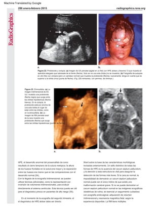 Figura 22. Probóscide y ciclopía. (a) Imagen de US prenatal sagital en un feto con HPE alobar y trisomía 13 que muestra el
apéndice alargado que sobresale de la frente (flecha). Solo se vio una sola órbita (no se muestra). (b) Fotografía de autopsia
en otro feto con ciclopía (pero un cariotipo normal) que muestra la probóscide (flecha); nuevamente, tenga en cuenta que es
superior a la órbita única (punta de flecha). (Fig. 22b reimpreso, con permiso, de Amirsys.)
Figura 23. Etmocefalia. (a) La
imagen tridimensional de EE.
UU. muestra una probóscide
(flecha negra) que surge entre
las órbitas hipotelóricas (flecha
blanca). En la ciclopía, la
probóscide está por encima de
una sola órbita en lugar de
estar entre las órbitas, como
en la etmocefalia. (b) La
imagen de RM prenatal axial
de la cara muestra una
probóscide (flecha) que surge
entre las órbitas hipotelóricas (puntas de flecha).
el diagnóstico de HPE alobar debe ser directo
Con la llegada de la ecografía tridimensional, se pueden
utilizar técnicas adicionales, como la representación por
inversión de volúmenes tridimensionales, para evaluar
directamente el sistema ventricular. Esta técnica puede ser útil
para el diagnóstico precoz en pacientes de alto riesgo (55).
Ward sobre la base de las características morfológicas
revisadas anteriormente. Un sello distintivo de todas las
formas de HPE es la ausencia del cavum septum pellucidum,
y la atención a esta estructura es vital para asegurar la
detección de las formas más leves. Si la cara es normal, la
imposibilidad de demostrar un cavum septum pellucidum
normal puede ser el único indicio de que existe una
malformación cerebral grave. Si no se puede demostrar un
cavum septum pellucidum normal en las imágenes ecográficas
obstétricas de rutina, es esencial un seguimiento cuidadoso
con ecografía endovaginal, adquisición de volumen
tridimensional y resonancia magnética fetal, según la
experiencia disponible. La RM tiene múltiples
HPE, el desarrollo anormal del prosencéfalo da como
resultado el cierre temprano de la sutura metópica; la altura
de los huesos frontales en la sutura era mayor y la separación
entre los huesos era menor que en las comparaciones con el
desarrollo normal (54).
En el momento de la ecografía del segundo trimestre, el
radiographics.rsna.org
286 enero-febrero 2015
Machine Translated by Google
 