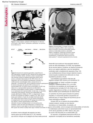 RG • Volumen 35 Número 1 Invierno y otros 277
La categorización común actual de HPE agrega otra entidad a las
tres clásicas: variante interhemisférica media (MIH)
Figura 3. Aprosencefalia. La imagen coronal de
resonancia magnética (RM) in utero muestra una
falla en la división normal del prosencéfalo (cerebro
anterior) en telencéfalo (cerebro) y diencéfalo
(tálamo, hipotálamo). Obsérvese la bóveda craneal
y el cuero cabelludo intactos (flechas) sin cerebro
supratentorial. La observación clave es que la hoz
está ausente (* = ubicación esperada de la hoz normal).
El extremo más grave del espectro HPE comienza en la
aprosencefalia (AP), el continuo entre la anencefalia y el HPE más
clásico (4). La aprosencefalia representa una falta total de
derivados prosencefálicos (cerebro anterior). La atelencefalia (AT)
es un subconjunto de la aprosencefalia: en este caso, un diencéfalo
rudimentario está presente, mientras que el telencéfalo está
ausente. (b) Espectro DeMyer de HPE. La categorización clásica
de HPE fue propuesta por DeMyer y colegas (7) en 1963, que va
desde grave (alobar), a través de una etapa intermedia (semilo
bar), hasta menos grave (lobar) en el otro extremo del espectro.
(dieciséis). Aunque morfológicamente no se encuentra entre
semilobar y lobar (ver texto para diferencias), la mayoría de los
autores lo ubican en esta región en términos de severidad, con
MIH quizás más similar al subtipo lobar según medidas funcionales (15,18).
Figura 1. Cerdo ciclópico, grabado de NF Regnault, en Morceau
de la Sarthe, 1808. Flecha = probóscide. (Reimpreso, con permiso,
de la referencia 2.)
Figura 2. Esquemas de espectros generales y específicos de
HPE. (a) Espectro completo de HPE. Además de las subdivisiones
clásicas de DeMyer (alobar, semilobar y lobar), los desarrollos
más recientes incluyen la displasia septo-óptica (SOD) menos
severa y entidades relacionadas (4,16); HPE mínimo (16), un
diagnóstico casi nunca realizado prenatalmente, asociado con
malformaciones craneofaciales sutiles y retraso leve en el
desarrollo; y microforma HPE, que por definición excluye la participación del cerebro (9,16).
(cerebro anterior), también se han descrito
anomalías en el mesencéfalo, el cerebelo y el
tronco del encéfalo, como la sinapsis del rombencéfalo (4,16,23,24).
Aunque HPE es un trastorno de prosencefálico
En resumen, el ingrediente esencial de HPE es la
separación incompleta de los hemisferios cerebrales.
el extremo menos afectado del espectro (es decir,
menos grave que el HPE lobar) (9,17,19), mientras
que otros lo incluyen en la categoría de línea media anormal
Las entidades en el extremo más leve del
espectro incluyen HPE mínimo y en microforma. En
la forma mínima, la “fusión” se limita a la región
preóptica o septal/subcallosa (16), y en el tipo
microforma, los resultados de neuroimagen son
completamente normales (9,21,22). Estos no se
pueden diagnosticar en el feto y no se discutirán más
allá de señalar que la identificación de estas formas
en parientes de primer grado (incluidos los padres)
respalda un componente genético subyacente con
potencial para un mayor riesgo de recurrencia que en
casos esporádicos aislados.
Las manifestaciones clínicas incluyen deterioro visual y
endocrinopatía resultante de la disfunción en el eje
hipotalámico-pituitario (16,20).
desarrollo (que puede ser más apropiado desde el
punto de vista embriológico). En SOD, hay hipoplasia
de los nervios ópticos y quiasma; se observa la ausencia
del ca vum septum pellucidum, pero los hemisferios
cerebrales están completamente separados (Figs. 5,6).
La heterotopía subcortical ocurre en aproximadamente
el 4% de los pacientes con HPE “clásico” (25), pero
es mucho más frecuente en la variante MIH (16).
Machine Translated by Google
 