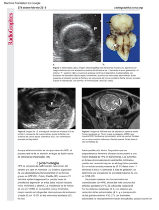 278 enero-febrero 2015 radiographics.rsna.org
HPE se considera la malformación más común del
cerebro y la cara en humanos (1). Existe la suposición
de una alta letalidad embrionaria/fetal en las formas
graves de HPE (26). Orioli y Castilla (27) revisaron 21
estudios epidemiológicos en los que las tasas de
prevalencia dependían de si los datos incluían nacidos
vivos, mortinatos o abortos. La prevalencia es de menos
de uno en 10 000 en los nacidos vivos y mortinatos,
mayor cuando se incluyen las interrupciones del embarazo
y hasta 50 por 10 000 en los embriones abortados (27).
No hay
Aunque el término fusión se usa para describir HPE, el
proceso real es de no escisión, en lugar de fusión activa
de estructuras emparejadas (16).
Se pueden observar muchas anomalías no
craneofaciales con HPE, siendo las más comunes los
defectos genitales (24 %), la polidactilia postaxial (8
%), los defectos vertebrales (5 %), los defectos por
reducción de las extremidades (4 %) y la transposición
de las grandes arterias. 4%) (27). Las anomalías
adicionales no necesariamente indican aneuploidía, porque ocurren en
fuerte predilección étnica. Se postula que una
preponderancia femenina al nacer es secundaria a una
mayor letalidad de HPE en los hombres. Los aumentos
en la tasa de prevalencia de nacimientos notificados
pueden ser causa de mejoras en el diagnóstico prenatal.
En un estudio estadounidense de 57 119 fetos entre 11
semanas 0 días y 13 semanas 6 días de gestación, se
determinó una prevalencia de encefalia holopros de uno
en 1298 (28).
Figura 5. Imagen de US endovaginal coronal que muestra SOD en
un feto. La presencia del cuerpo calloso (punta de flecha) con
ausencia del cavum ayudó a identificar SOD, con confirmación
posnatal del diagnóstico.
Figura 6. Imagen de RM fetal axial de adquisición rápida de medio
Fourier ponderada en T2 con realce de relajación (RARE) que
muestra SOD. Se observa comunicación entre los cuernos frontales
con un cavum septum pellucidum (flecha) ausente. No se observó
otra normalidad ab.
Figura 4. Atelencefalia. (a) La imagen ultrasonográfica (US) transversal muestra una apariencia sin
rasgos distintivos sin una arquitectura cerebral identificable a las 21 semanas de edad gestacional. A =
anterior, P = posterior. (b) La muestra de autopsia confirma el diagnóstico de atelencefalia, con
formación del diencéfalo (flecha negra) únicamente y ausencia de estructuras telencefálicas. Están
presentes el cerebelo (puntas de flecha) y las estructuras del tronco encefálico (flecha blanca) normales.
(Figura 4b reproducida, con permiso, de Amirsys [Salt Lake City, Utah]).
Epidemiología
Machine Translated by Google
 