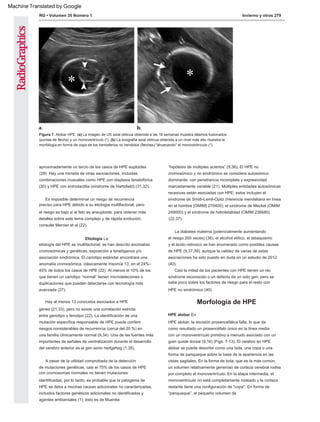Es imposible determinar un riesgo de recurrencia
preciso para HPE debido a su etiología multifactorial, pero
el riesgo es bajo si el feto es aneuploide; para obtener más
detalles sobre este tema complejo y de rápida evolución,
consulte Mercier et al (22).
A pesar de la utilidad comprobada de la detección
de mutaciones genéticas, casi el 75% de los casos de HPE
con cromosomas normales no tienen mutaciones
identificadas; por lo tanto, es probable que la patogenia de
HPE se deba a muchas causas adicionales no caracterizadas,
incluidos factores genéticos adicionales no identificados y
agentes ambientales (1); esto es de Muenke
Casi la mitad de los pacientes con HPE tienen un rec
HPE alobar En
HPE alobar, la escisión prosencefálica falla, lo que da
como resultado un prosencéfalo único en la línea media
con un monoventrículo primitivo a menudo asociado con un
gran quiste dorsal (9,16) (Figs. 7-13). El cerebro en HPE
alobar se puede describir como una bola, una copa o una
forma de panqueque sobre la base de la apariencia en las
vistas sagitales. En la forma de bola, que es la más común,
un volumen relativamente generoso de corteza cerebral rodea
por completo el monoventrículo. En la etapa intermedia, el
monoventrículo no está completamente rodeado y la corteza
restante tiene una configuración de "copa". En forma de
“panqueque”, el pequeño volumen de
síndrome reconocido o un defecto de un solo gen, pero se
sabe poco sobre los factores de riesgo para el resto con
HPE no sindrómico (40).
“hipótesis de múltiples aciertos” (9,36). El HPE no
cromosómico y no sindrómico se considera autosómico
dominante, con penetrancia incompleta y expresividad
marcadamente variable (21). Múltiples entidades autosómicas
recesivas están asociadas con HPE; estos incluyen el
síndrome de Smith-Lemli-Opitz (Herencia mendeliana en línea
en el hombre [OMIM] 270400), el síndrome de Meckel (OMIM
249000) y el síndrome de hidroletalidad (OMIM 236680)
(22,37).
Hay al menos 13 conocidos asociados a HPE
La diabetes materna (potencialmente aumentando
el riesgo 200 veces) (38), el alcohol etílico, el tabaquismo
y el ácido retinoico se han enumerado como posibles causas
de HPE (9,37,39), aunque la validez de varias de estas
asociaciones ha sido puesto en duda en un estudio de 2012
(40).
aproximadamente un tercio de los casos de HPE euploides
(29). Hay una miríada de otras asociaciones, incluidas
combinaciones inusuales como HPE con displasia tanatofórica
(30) y HPE con ectrodactilia (síndrome de Hartsfield) (31,32).
genes (21,33), pero no existe una correlación estricta
entre genotipo y fenotipo (22). La identificación de una
mutación específica responsable de HPE puede conferir
riesgos considerables de recurrencia (cerca del 20 %) en
una familia clínicamente normal (9,34). Una de las fuentes más
importantes de señales de ventralización durante el desarrollo
del cerebro anterior es el gen sonic hedgehog (1,35).
Etiología La
etiología del HPE es multifactorial: se han descrito anomalías
cromosómicas y genéticas, exposición a teratógenos y/o
asociación sindrómica. El cariotipo estándar encontrará una
anomalía cromosómica, clásicamente trisomía 13, en el 24%–
45% de todos los casos de HPE (22). Al menos el 10% de los
que tienen un cariotipo “normal” tienen microdeleciones o
duplicaciones que pueden detectarse con tecnología más
avanzada (27).
Invierno y otros 279
RG • Volumen 35 Número 1
Morfología de HPE
Figura 7. Alobar HPE. (a) La imagen de US axial oblicua obtenida a las 18 semanas muestra tálamos fusionados
(puntas de flecha) y un monoventrículo (*). (b) La ecografía axial oblicua obtenida a un nivel más alto muestra la
morfología en forma de copa de los hemisferios no hendidos (flechas) "ahuecando" el monoventrículo (*).
Machine Translated by Google
 