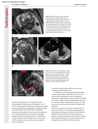 RG • Volumen 35 Número 1 Invierno y otros 281
Figura 13. Alobar HPE. Imagen sagital de ecografía
Dop pler en color de una cabeza fetal que muestra el
signo de la “serpiente debajo del cráneo”: una sola
arteria cerebral anterior (flecha), también conocida
como arteria cerebral anterior ácida, desplazada
anteriormente para pasar por debajo de los huesos
frontales, en lugar de de entre los lóbulos frontales
como en un cerebro formado normalmente.
Figura 12. Alobar HPE. (a) La imagen de RM fetal
coronal muestra un monoventrículo (*), tálamos
fusionados (flechas) y tejido cerebral mínimo (puntas
de flecha). (b) Imagen sagital de RM semi-Fourier
RARE ponderada en T2 que muestra una parte media
de la cara aplanada (flecha) y la configuración de "bola"
de la corteza restante (puntas de flecha) que rodean el
monoventrículo (*). (c) La imagen coronal de EE. UU.
en el recién nacido confirma el monoventrículo único
(*), los tálamos fusionados (flechas) y un mínimo tejido
cerebral suprayacente (puntas de flecha).
Como era de esperar en un continuo de malformación, la
distinción precisa entre HPE semilobar y lobar puede ser
problemática; sin embargo, si se forma el tercer ventrículo,
hay alguna formación de cuerno frontal y se forman el
esplenio y el cuerpo posterior del cuerpo calloso, la entidad
puede clasificarse como lobar (9). Se ha propuesto que un
diagnóstico fetal específico de HPE lobular puede
Las malformaciones faciales suelen ser leves o estar
ausentes en el HPE semilobar (16).
hemisferios clasificados (4), con la extensión anterior
correspondiente a la de la fisura interhemisférica (19). Un
criterio un tanto arbitrario utilizado en las imágenes posnatales
es que la malformación es semilobular si los lóbulos frontales
están fusionados en más del 50% (16). Las imágenes
posnatales también muestran diversos grados de separación
de los núcleos profundos, pero el tálamo y el hipotálamo
pueden permanecer sin separarse (es decir, “fusionados”).
Cuando hay fusión talámica, puede haber un quiste dorsal
en HPE semilobar y, si son grandes, los quistes pueden
causar macrocefalia.
En HPE lobar, la fisura interhemisférica está presente
a lo largo de casi toda la línea media (Figs. 18,19), y los
tálamos están completamente o casi completamente
separados. El cuerpo calloso puede ser normal o incompleto,
pero el cavum septum pellucidum siempre está ausente (4).
Los cuernos frontales rudimentarios son típicos (19), y solo
las porciones más inferiores de los lóbulos frontales están
fusionadas.
Machine Translated by Google
 