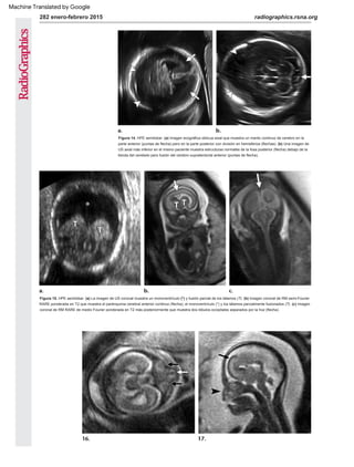 282 enero-febrero 2015 radiographics.rsna.org
Figura 15. HPE semilobar. (a) La imagen de US coronal muestra un monoventrículo (*) y fusión parcial de los tálamos (T). (b) Imagen coronal de RM semi-Fourier
RARE ponderada en T2 que muestra el parénquima cerebral anterior continuo (flecha), el monoventrículo (*) y los tálamos parcialmente fusionados (T). (c) Imagen
coronal de RM RARE de medio Fourier ponderada en T2 más posteriormente que muestra dos lóbulos occipitales separados por la hoz (flecha).
Figura 14. HPE semilobar. (a) Imagen ecográfica oblicua axial que muestra un manto continuo de cerebro en la
parte anterior (puntas de flecha) pero en la parte posterior con división en hemisferios (flechas). (b) Una imagen de
US axial más inferior en el mismo paciente muestra estructuras normales de la fosa posterior (flecha) debajo de la
tienda del cerebelo pero fusión del cerebro supratentorial anterior (puntas de flecha).
Machine Translated by Google
 