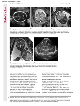 Invierno y otros 283
RG • Volumen 35 Número 1
Figura 18. HPE lobar. (a) La imagen axial de US muestra un eco continuo en la línea media anteriormente (flecha). No pudimos demostrar el cavum
septum pellucidum en ningún plano. (b) La imagen de RM fetal axial muestra una división aparentemente completa de los hemisferios cerebrales
(puntas de flecha). (c) La imagen de RM fetal coronal muestra la continuidad del giro anteroinferior entre los lóbulos frontales (flecha). Esto no fue
demostrable en EE.UU.; el hallazgo índice fue la incapacidad para demostrar un cavum septum pellucidum normal.
Figura 19. HPE lobar. (a) La imagen de RM fetal muestra la continuidad de los lóbulos frontales a lo largo de la línea
media (flecha), la presencia del cuerpo calloso (punta de flecha) y la ausencia del cavum septum pellucidum. (b) La
imagen de US coronal posnatal muestra fusión de los lóbulos frontales anteriores (*) con interdigitación de surcos a lo
largo de la línea media (flechas).
Figuras 16, 17. Semilobar HPE. (16) Imagen de RM RARO medio-Fourier ponderada en T2 axial que muestra lóbulos occipitales separados con
características faciales anormales, que incluyen hipotelorismo (flechas negras) y una nariz tubular (flecha blanca), que demostró tener una sola fosa
nasal en imágenes obtenidas en otros aviones (17) Imagen sagital de RARE RARE de medio Fourier ponderada en T2 que muestra la morfología de
"bola", con el cerebro (flecha) rodeando el monoventrículo (*). Obsérvese el perfil anormal y aplanado (punta de flecha).
hacerse cuando hay un fórnix fusionado (como lo
demuestra una estructura lineal ecogénica que corre
anteroposteriormente dentro del tercer ventrículo) (43).
Investigadores más recientes han sugerido que esta
observación no es específica para HPE lobar (como se
define por la fusión de al menos una circunvolución a
través de la línea media), sino que se observa con otras
anomalías cerebrales de la línea media, incluido el
desarrollo anormal del cuerpo calloso y SOD (44).
Variante interhemisférica media La
variante MIH, descrita por primera vez por Barkovich
y Quint (46) en 1993, es un subtipo clínico-
neurorradiológico distinto de HPE (18) (Figs. 20, 21).
El colorido signo de "serpiente bajo el cráneo"
describe la ruta de la arteria cerebral anterior
directamente debajo de los huesos frontales a medida
que se desplaza hacia adelante por el tejido cortical anormal.
El diagnóstico fetal es posible (47,48).
En el espectro de HPE alobar a lobar, el área más
severamente no separada es el cerebro anterior basal,
mientras que en MIH, son los lóbulos frontal posterior y
parietal los que no se dividen (19). Espectáculos de imágenes
de los lóbulos frontales "fusionados". Puede verse en
todas las formas de HPE y puede usarse para ayudar
con el diagnóstico prenatal de HPE lobar versus SOD (45).
Machine Translated by Google
 