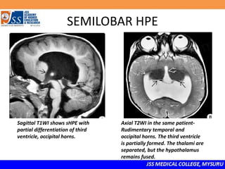 SEMILOBAR HPE
Sagittal T1WI shows sHPE with
partial differentiation of third
ventricle, occipital horns.
Axial T2WI in the same patient-
Rudimentary temporal and
occipital horns. The third ventricle
is partially formed. The thalami are
separated, but the hypothalamus
remains fused.
 