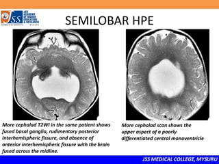 SEMILOBAR HPE
More cephalad T2WI in the same patient shows
fused basal ganglia, rudimentary posterior
interhemispheric fissure, and absence of
anterior interhemispheric fissure with the brain
fused across the midline.
More cephalad scan shows the
upper aspect of a poorly
differentiated central monoventricle
 